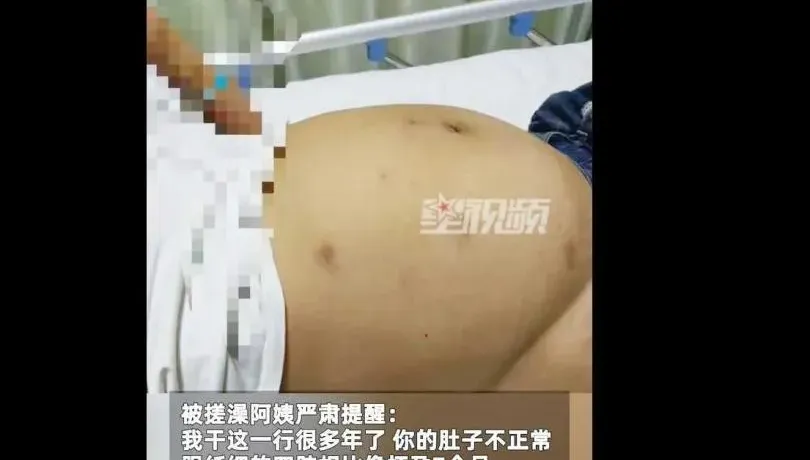女大生肚子大到像青蛙　以為自己「蘋果型身材」被搓澡阿姨救一命