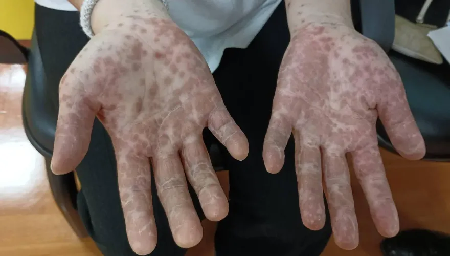 快訊/疫情升溫！預期4月底進入腸病毒流行期　新北市中和區為高風險區