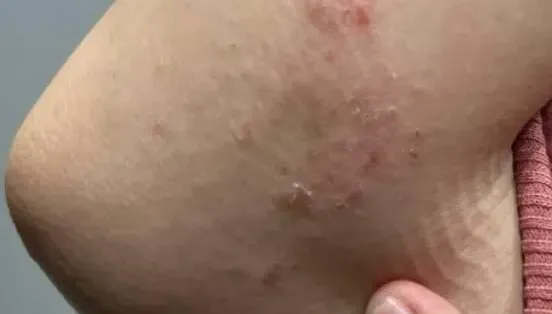28歲女皮膚紅癢難耐　濕疹反覆不癒！規律服中藥…經期不順也有效