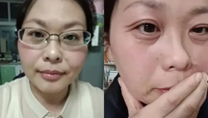 42歲女「斷崖式衰老」！20天臉上佈滿皺紋　8生活習慣是老化加速器