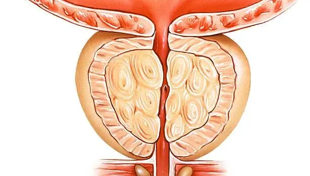 男性必看！醫列「10大NG習慣」啃蝕攝護腺健康　射精次數太少也上榜