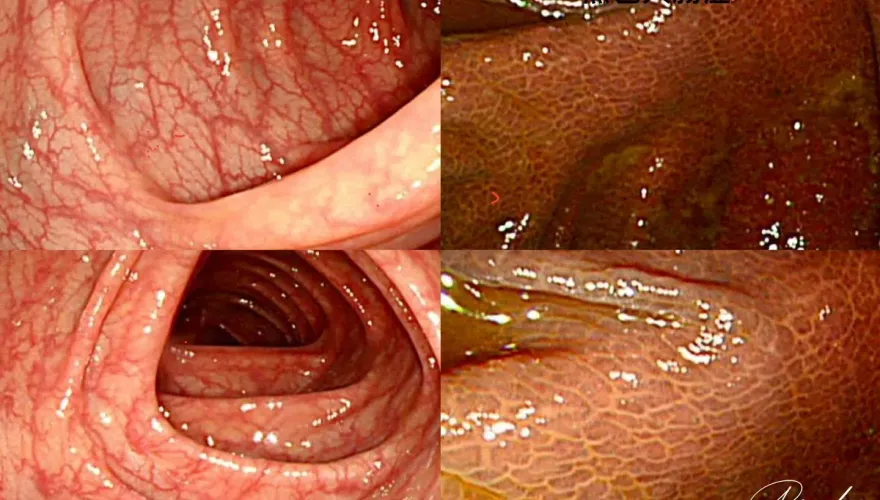 大腸鏡一照大腸都黑色的？竟是「黑色大腸症」醫揭：與排便狀況有關