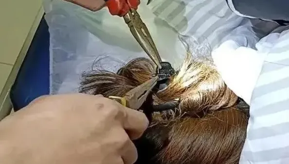 女子車禍！頭上「鯊魚夾」插進頭皮　用「鉗子」才拔出來