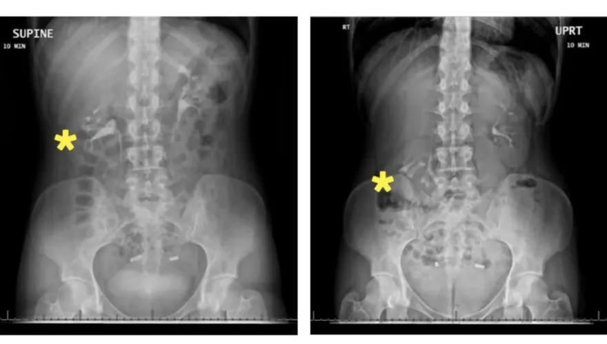 女高中生腰痠又頻尿　一照腎臟超音波驚見「腎下垂」！醫曝：纖細身材是原因