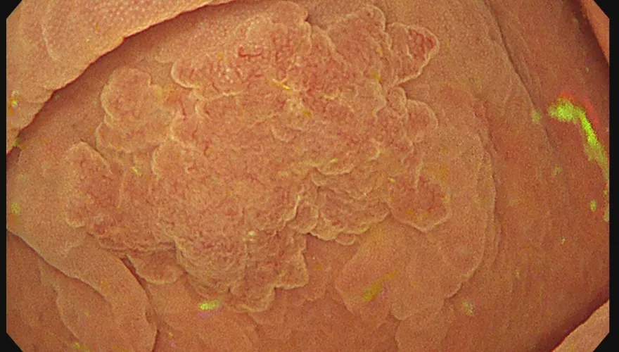 才照完大腸鏡正常！「1年後驚見息肉」醫揭驚人真相：當心大腸間隔癌