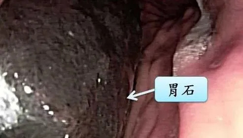 8旬老翁胃痛求診　照胃鏡驚見「5公分大黑石」！醫授：喝可樂軟化結石