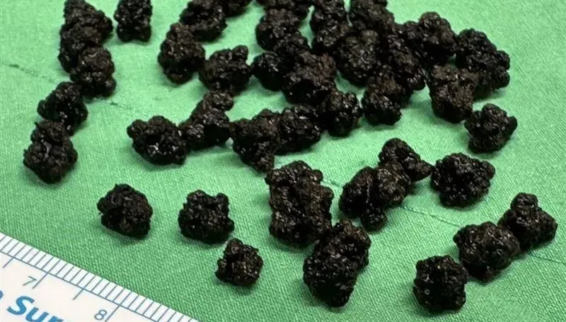 7旬翁腹痛、腰痛血尿「膽結石」開刀！醫護驚：好像高山茶葉