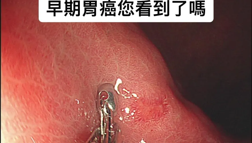 5旬男腹脹多年　近期食慾不振！內視鏡一看「胃壁隆起0.5公分」醫揪早期胃癌