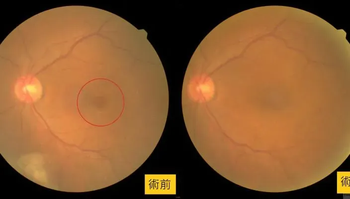 6旬男左眼前黑影以為白內障！檢查「黃斑部」竟破了一個洞
