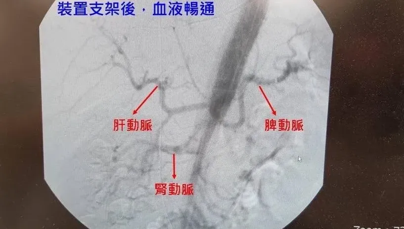 43歲男子肚子劇痛　就醫一看竟然是「主動脈剝離」惹禍！