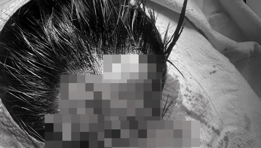 驚人傷勢曝光！Toyz頭破一個大洞「縫了至少10多針」　網怒批「要殺人是不是？」