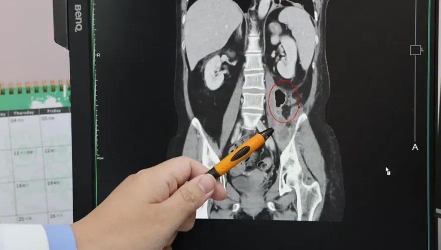 工人喝酒「急性背痛」！一查竟細菌感染「腰大肌膿瘍」嚴重恐敗血症
