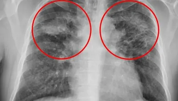 「人造石產業」後遺症！44歲男「矽肺症」吸入粉塵釀肺部纖維化