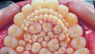 有圖！5歲童罹罕病長滿「300顆牙齒」超密集照片曝