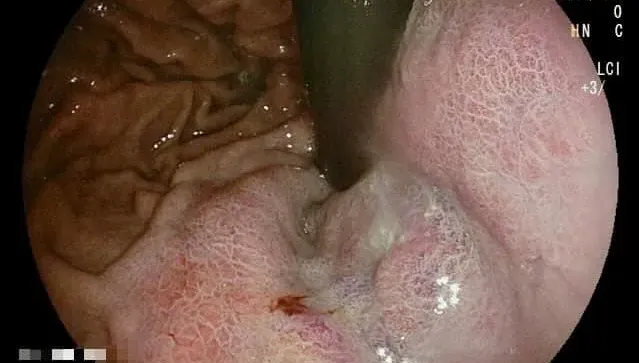 他飯後食物卡胸口！催吐竟伴隨血絲　胃鏡檢查驚見5公分大腫瘤