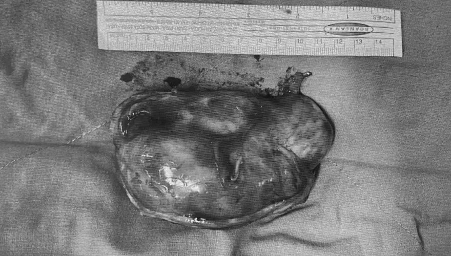 有圖！老婦後腿摸到腫塊...7天後「悄悄長大了」　化驗結果竟是惡性肉瘤