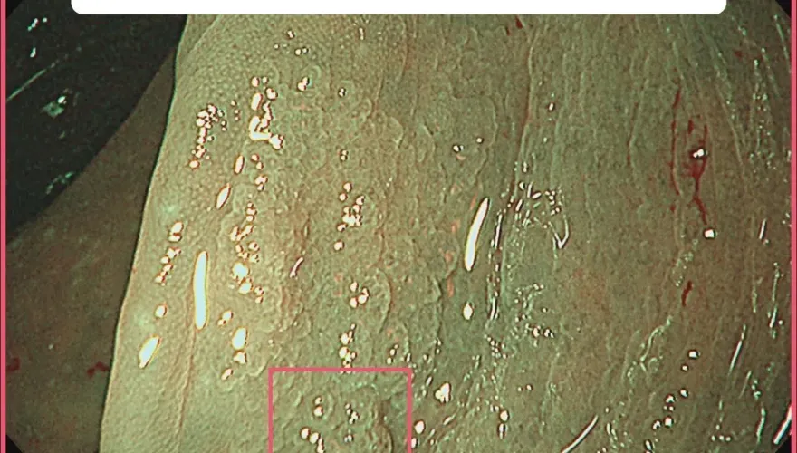 1瘜肉25%恐變大腸癌！35歲女檢出2cm鋸齒狀瘜肉！醫曝：糞便潛血恐檢查不到