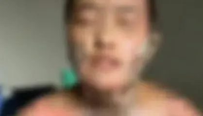 渣男潑妻子滿身酒再點火！她全身盡毀淚訴「他看我被燒還在笑」