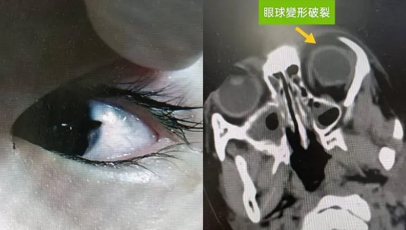 4歲女童美工刀誤認成筆！眼球遭「美工刀刺破」…眼白被劃開