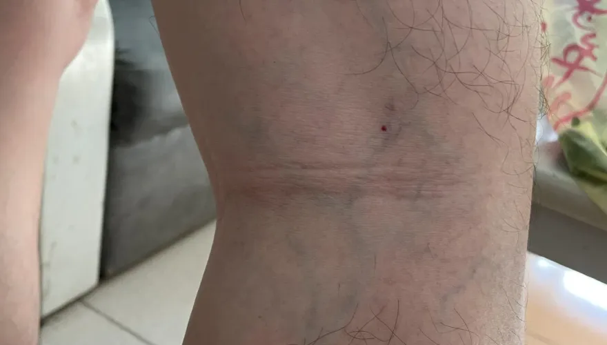 長時間站立開刀　小腿爬滿青綠色蚯蚓！醫師自曝：無法避免...