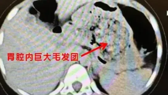 5歲女童腹痛難耐！醫從胃裡取出「一大坨毛髮」　確診為「長髮公主症候群」