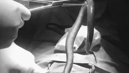 超越椰子！越南男肚子劇痛　開刀夾出「30公分鰻魚」還活著