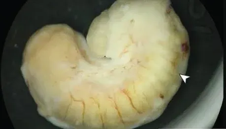 她眼球長「腫塊」拖2年才就醫！驚見寄生蟲蠕動　疑吃鱷魚肉感染