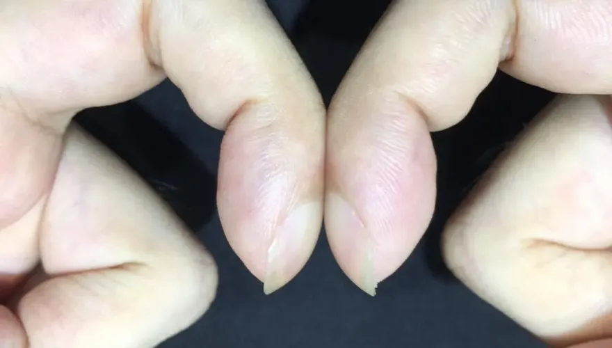 指甲變得厚又圓？「杵狀指」恐是患肺癌早期徵兆　一動作測試能救命