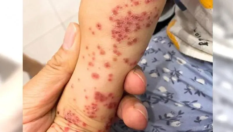 腸病毒大軍攻台！疫苗有哪些？1圖速懂差異　10招有效預防感染