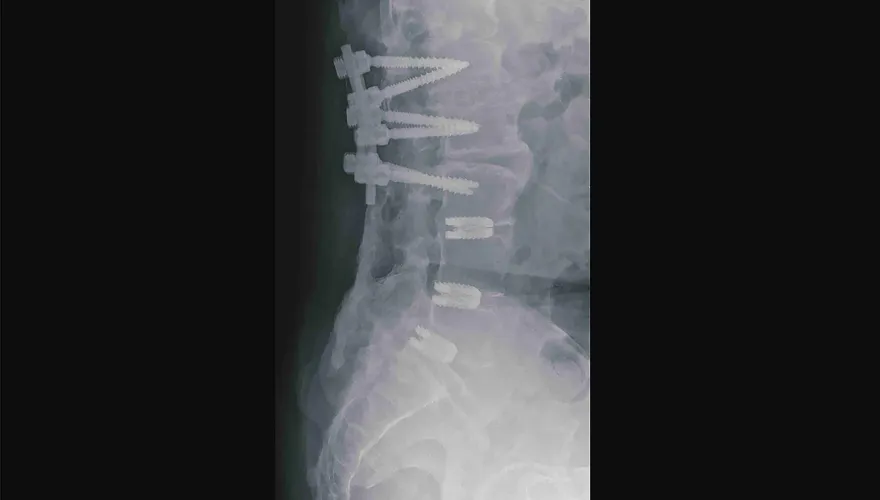 花30萬開腰椎手術！骨釘全打滿「下肢仍無力」醫一看：開錯地方了