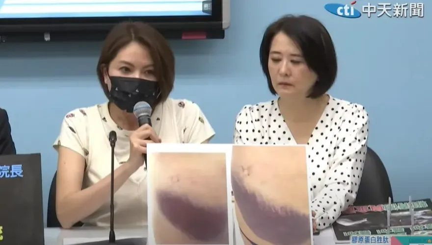 影/陳菁徽痛哭曝傷勢照片！臀部、腰部遭鍾佳濱魔爪「超大片瘀青」怵目驚心