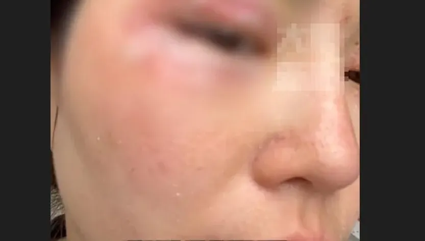 會飛的硫酸？女遭隱翅蟲襲眼「隔天眼周潰爛起泡」 醫生：千萬不可打