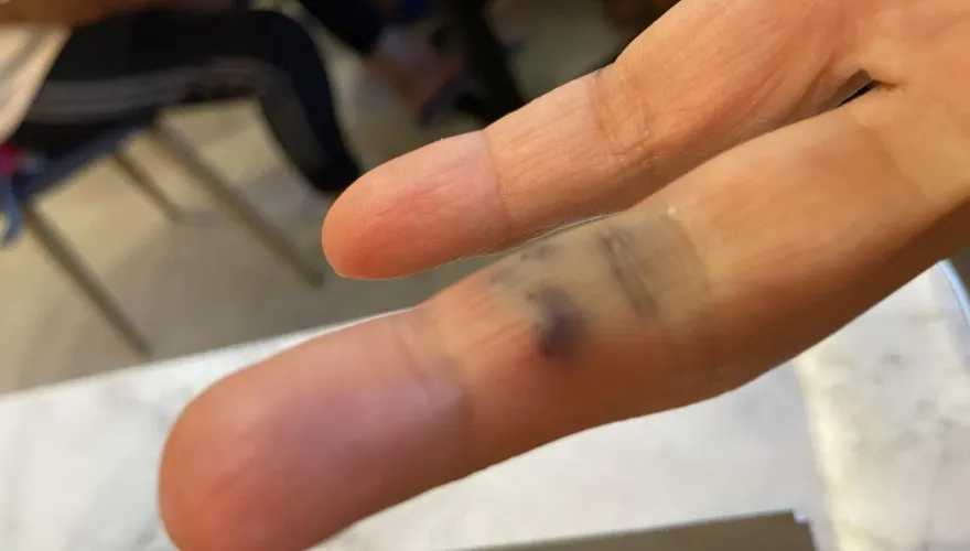 小琉球遊客遭海膽刺傷！「10幾根黑刺」插手指　慘變蜂窩性組織炎