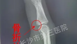 啪！女子一巴掌打蚊子「手指腫脹疼痛」　到醫院檢查竟「骨折了」