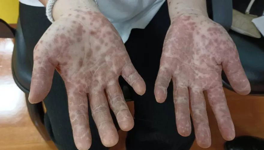 腸病毒疫情反轉上升！留意「喉嚨腫痛」症狀　估計9月開學再掀高峰