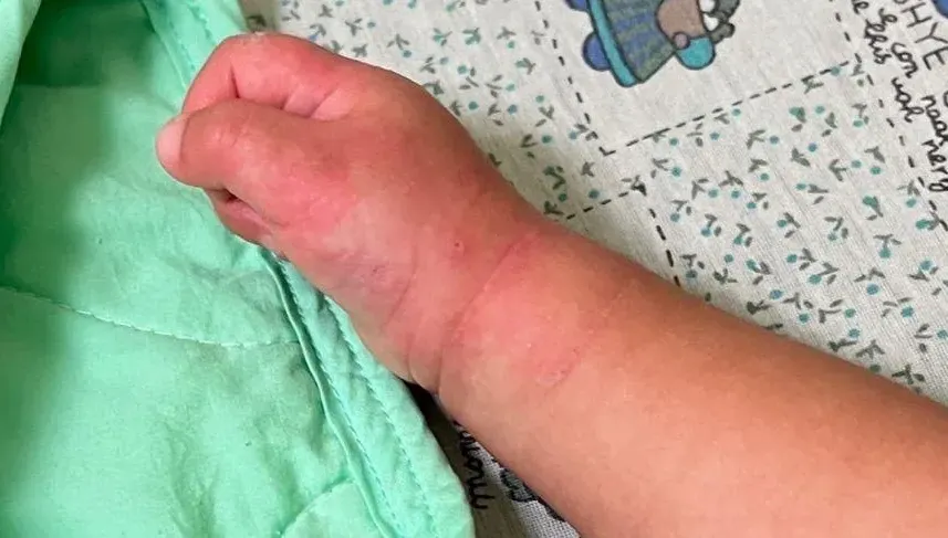 1歲嬰「發燒+起紅疹+ 卡介苗腫脹」竟是川崎氏症！嚴重恐影響心臟
