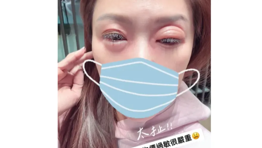 不只名牌包被偷！佩甄旅遊大過敏　眼皮突「腫到變形」慘況曝光