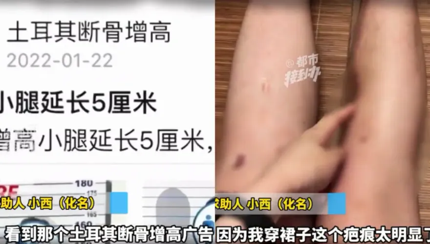 花275萬「斷骨」增高13公分　陸女術後「患骨髓炎」大崩潰：人生毀了