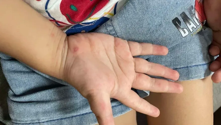 開學腸病毒群魔亂舞！首周已停課72班　家長注意小孩「5大症狀」
