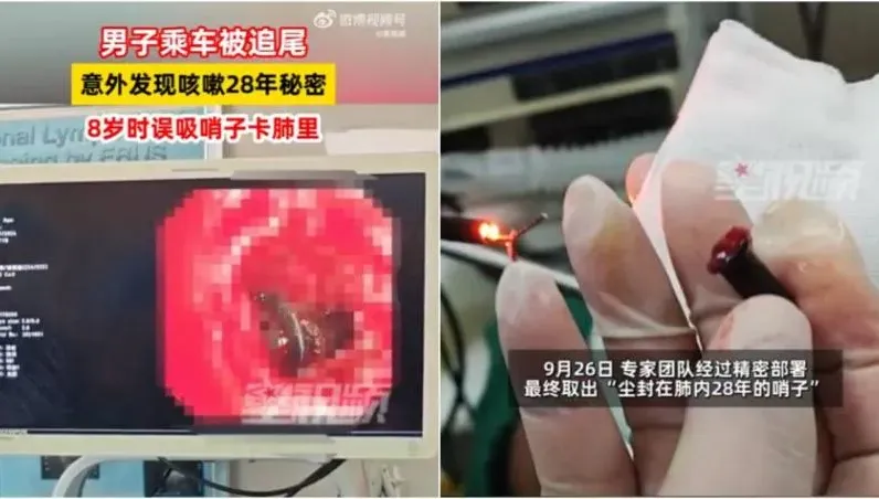 因禍得福！陸男「咳嗽28年不癒」...搭公車遇追撞體檢發現元凶是「它」