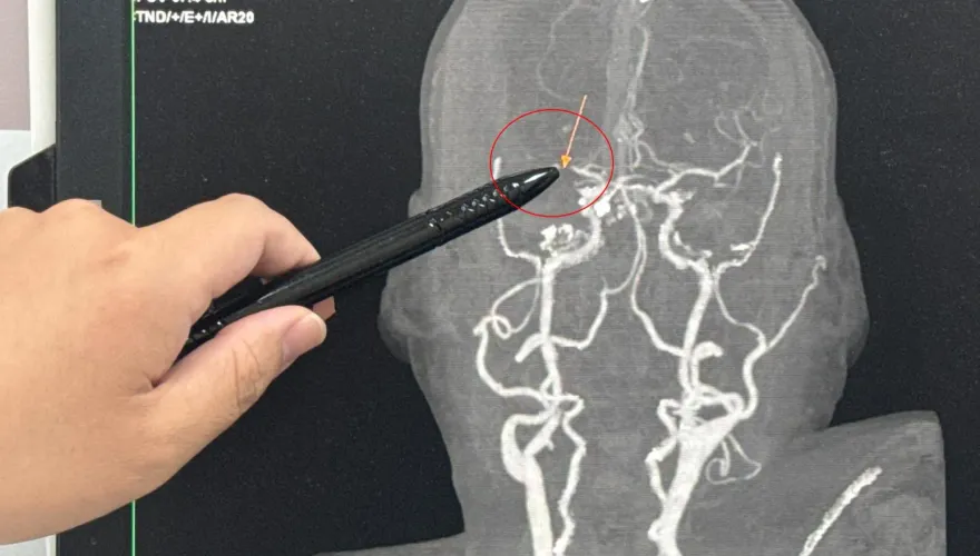 嫌妻煮飯太清淡！他愛吃「荷包蛋＋醬油」竟眼球脫窗腦中風