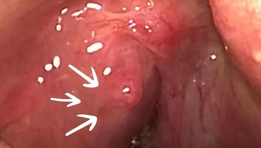 他喉嚨痛3天「扁桃腺周圍膿瘍」壓迫呼吸道只剩一半