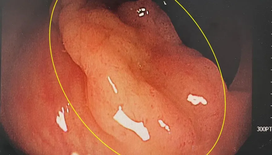 婦僅「便便不成形」竟揪出5cm腫瘤　醫：再晚會變大腸癌