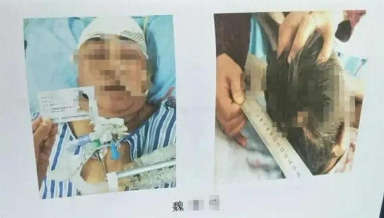 被「嚇死」！甘肅女目睹母親車禍後胸悶心悸　5天後竟猝死