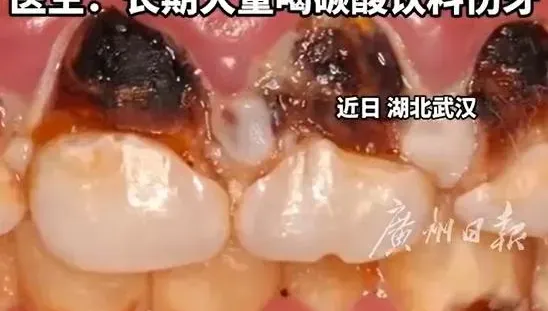 影/可樂當水喝…武漢少女整排牙被「泡腐」觸目驚心