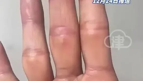 影/沒簽約沒培訓…陸男不熟儀器誤觸輻射源　手爛慘將截肢