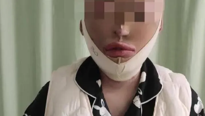 恐怖！湖北男不滿分手潑汽油　致女友全身7成燒傷毀容截肢