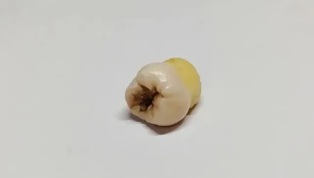 滿口蛀牙不治療！泰婦全身無力急送醫　細菌感染害「腦膿瘍」