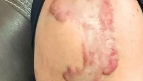 男業務「蟹足腫」爬滿手！年輕人、深膚色者罹患風險高
