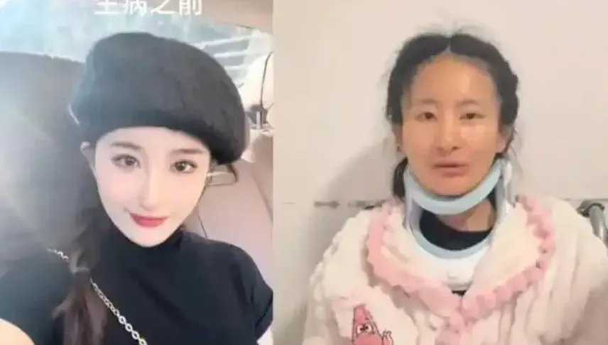 影/判若兩人！陸26歲正妹確診漸凍症「1年容貌巨變」